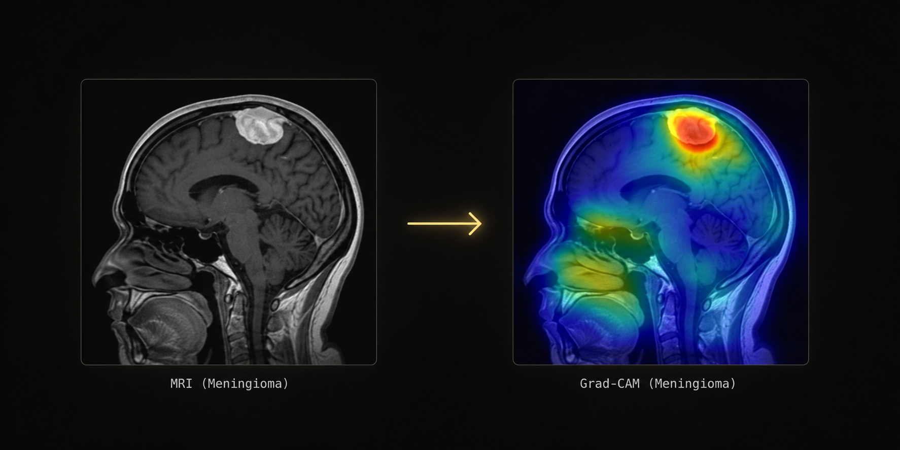 Brain MRI Tumor Classification